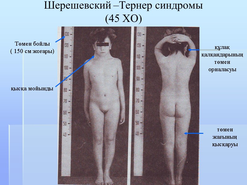 Шерешевский –Тернер синдромы (45 ХО) Төмен бойлы ( 150 см жоғары) қысқа мойынды төмен